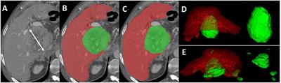 Feasibility of Automated Volumetric Assessment of Large Hepatocellular Carcinomas' Responses to Transarterial Chemoembolization